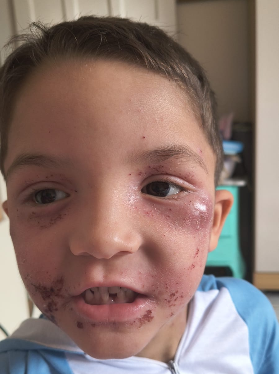 Feridas no rosto de Luís causadas pela dermatite