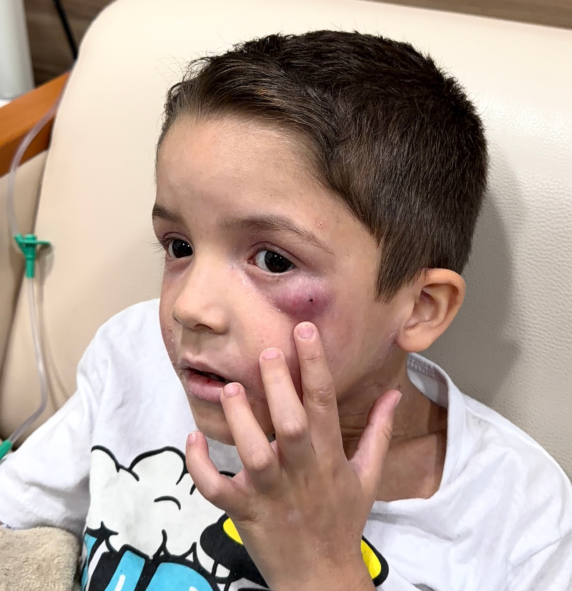 Luís mostrando as marcas da dermatite no rosto